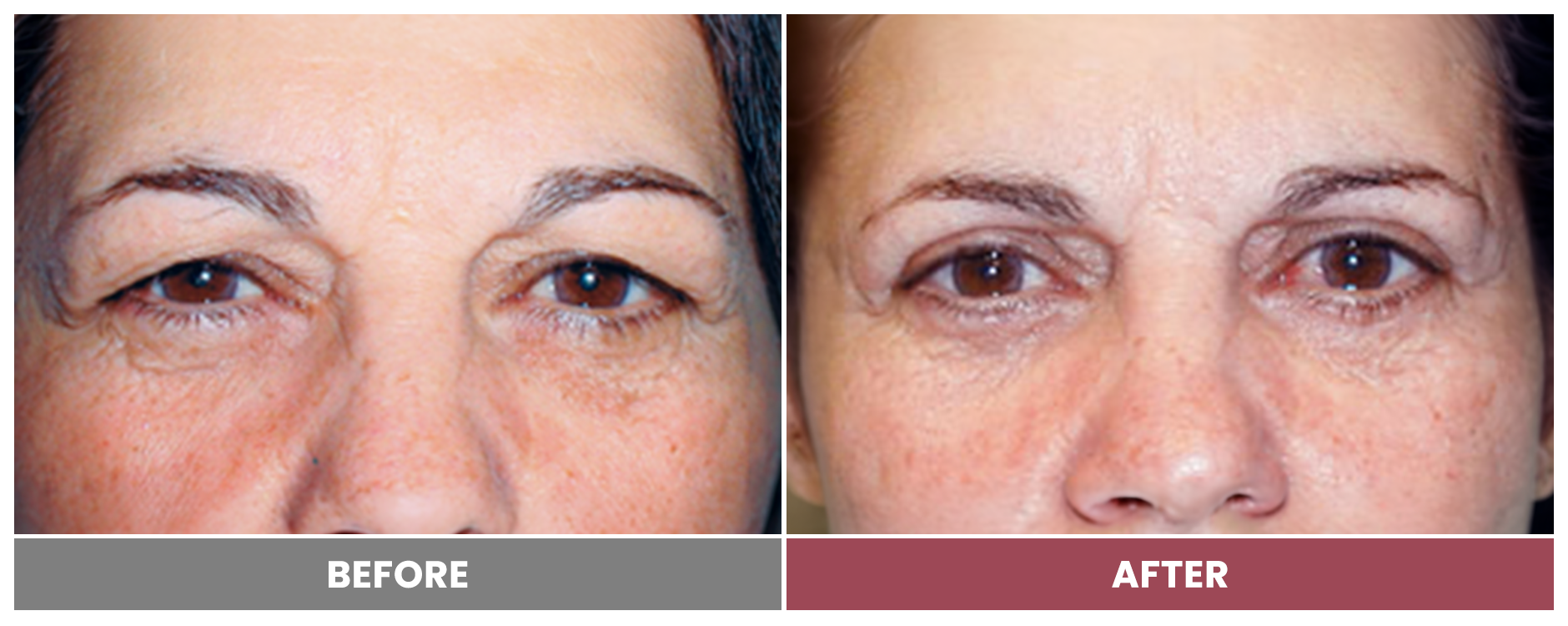 Upper Blepharoplasty - Case 39